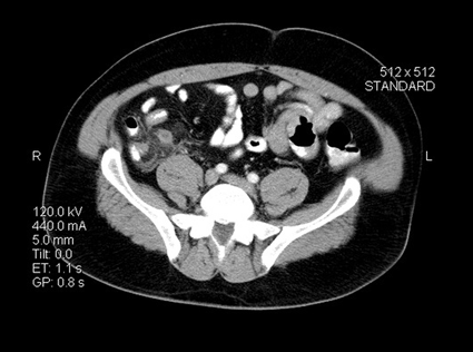 Image: An axial cross sectional CT image through the upper pelvis showing a typical example of acute appendicitis (Photo courtesy of Living Art Enterprises, LLC).